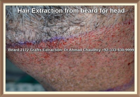 Body Hair Extraction- Scalp Success Rate