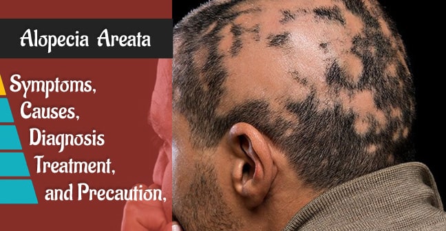 what is the best treatment for alopecia areata in Pakistan