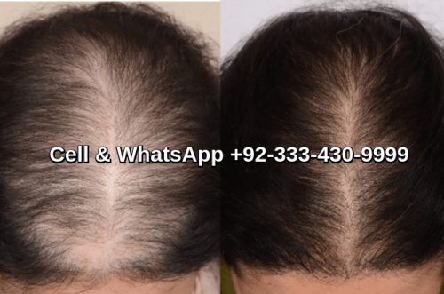 Female pattern baldness treatment Lahore Pakistan