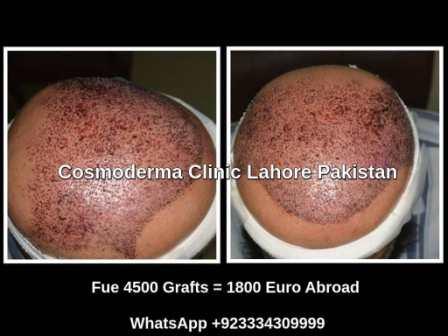 hair transplant treatment Lahore Pakistan