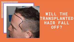 transplanted hair fall out