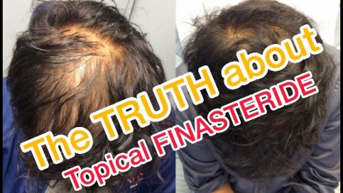 Topical Finasteride treatment Lahore