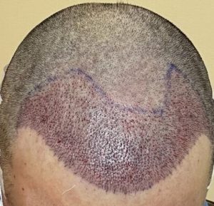 After grafts placement