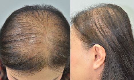 Female pattern diffuse baldness