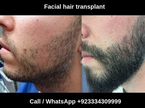 Facial hair restoration surgery Lahore