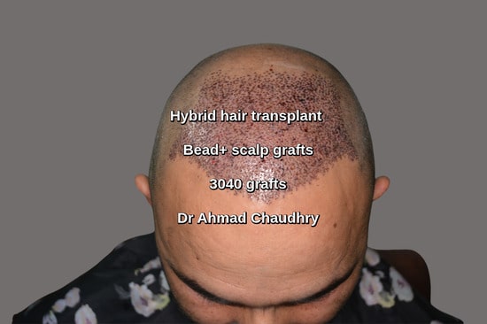 Hybrid hair transplant Lahore