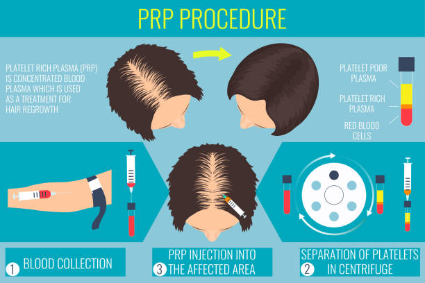 PRP treatment different steps
