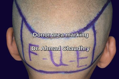 Fue hair transplant donor area marking Bahria town