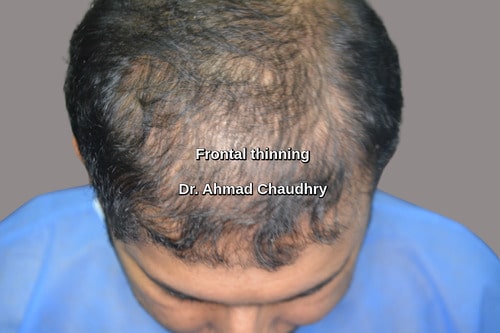 Hair transplant Dammam patient