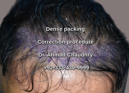Dense packing hair restoration London UK patient