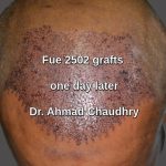 Hair transplant Chichawatni patient