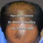 Male hair loss before