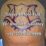 Shave before Fue procedure Chichawatni patient