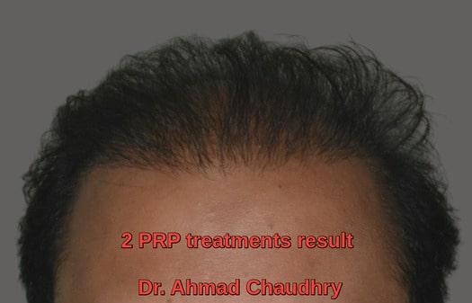 PRP for hair loss two sessions result