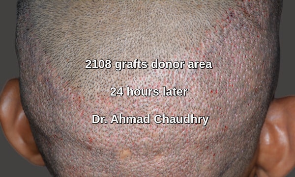 Fue donor area 24 hours later Southampton UK patient