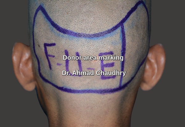 Fue donor area marking United Kingdom patient