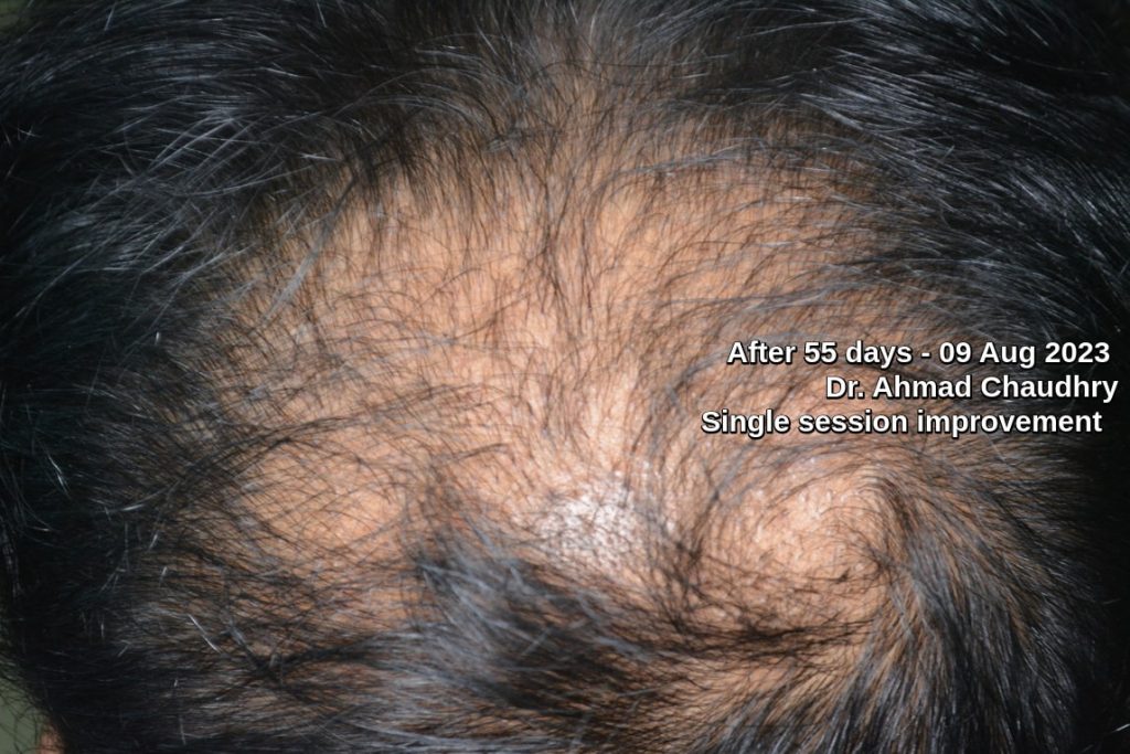 55 days later hair growth treatment Lahore
