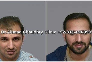 FUE-2800-grafts-hair-restoration-results-lahore-640x480-1-min