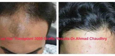 Fue-hair-transplant-Results-Pakistan-1024x417-min