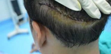 Will-hair-regrow-after-hair-transplant-on-donor-area-min